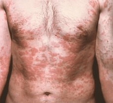 La peau à problèmes est un symptôme de la présence de parasites