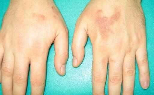 Les douleurs dans les articulations des mains peuvent être des symptômes de parasites