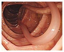 Parasites dans le corps humain